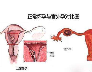 贵阳在做代孕是个什么感受|珠海黄姐去日本助孕试管中孕早期见红怎么办？
